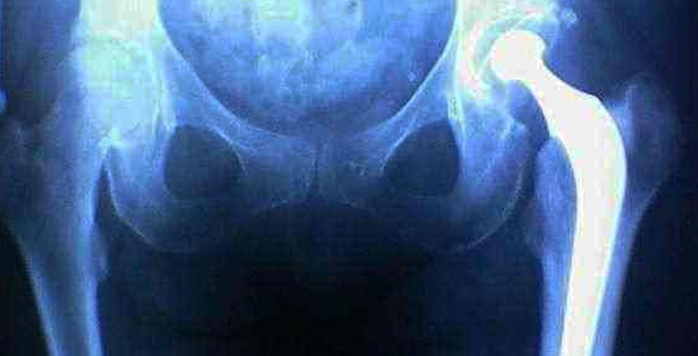 Hip XRay
